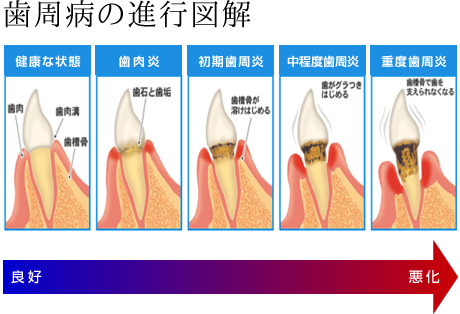歯周病の進行図解